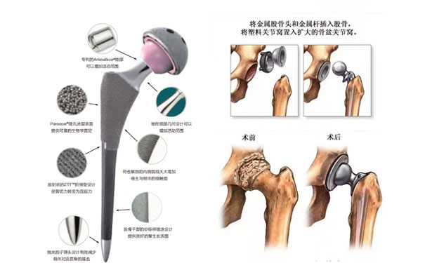 什么是人工髖關節置換，怎么進行髖關節置換術后康復？